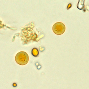 Endolimax nana cyst stained with Lugol